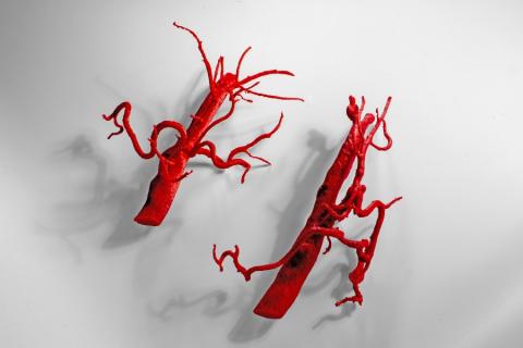 3D Prints of an Abdominal Aorta and Its Major Branches